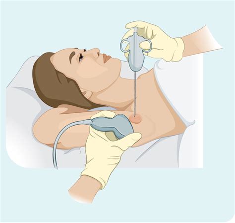 Surgical Lymph Node Biopsy for the Diagnosis of Lymphoma: A .